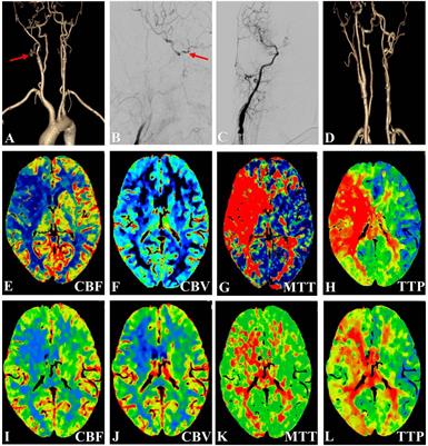 A Treatment Option for Symptomatic Chronic Complete Internal Carotid Artery Occlusion: Hybrid Surgery